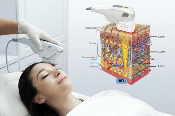 HIFU là gì?