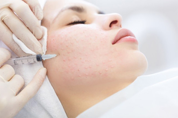 Phương pháp mesotherapy có tốt không?